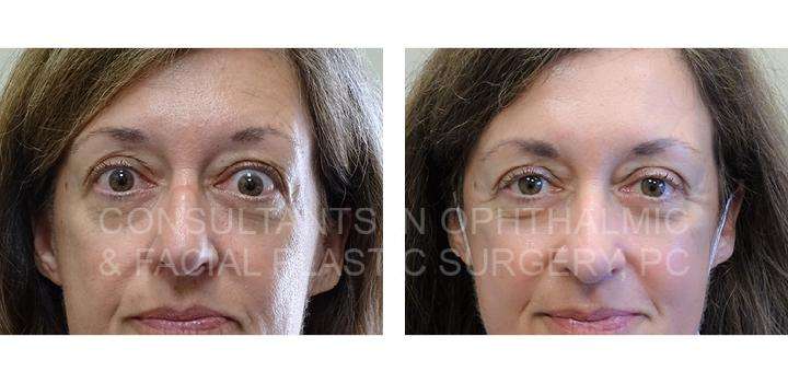 Retraction of Right Upper Eyelid / Right Lateral Canthoplasty - Consultants in Ophthalmic and Facial Plastic Surgery