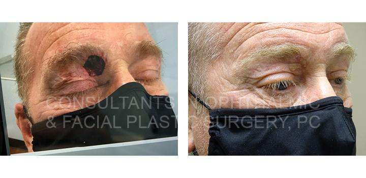 Full Thickness Skin Graft from the Preauricular Area to the Right Upper Eyelid - Consultants in Ophthalmic and Facial Plastic Surgery