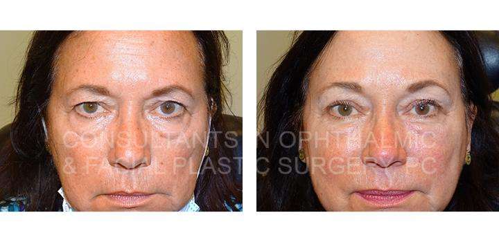Endoscopic Forehead and Brow Lift - Eyelid Pros
