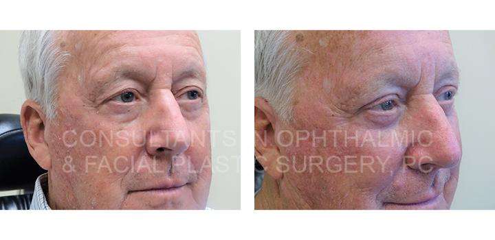 Excision Herniated Orbital Fat of Both Lower Eyelids with Co2 Laser / Repair Ptosis Both Upper Eyelids / Excision Lesions Left Upper and Left Lower Eyelids - Consultants in Ophthalmic and Facial Plastic Surgery