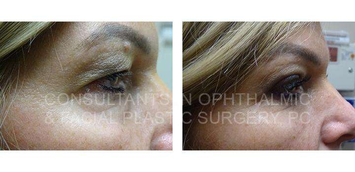 Transconjunctival Blepharoplasty with Excision Herniated Orbital Fat of Both Lower Lids / Blepharoplasty of Both Upper Eyelids - Consultants in Ophthalmic and Facial Plastic Surgery