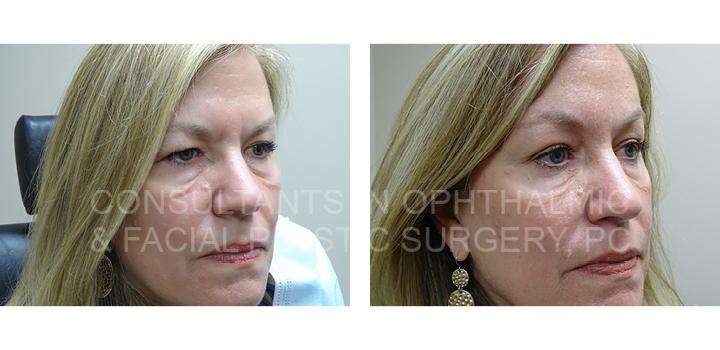 Blepharoplasty of Both Upper Eyelids / Endoscopic Forehead and Brow Lift - Consultants in Ophthalmic and Facial Plastic Surgery