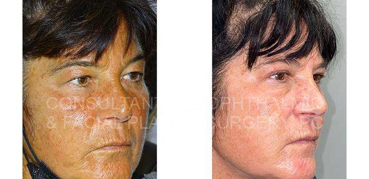 Blepharoplasty of both upper lids 3