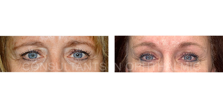 Endoscopic forehead and brow lift / Blepharoplasty of both upper lids