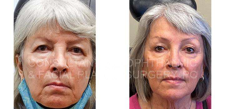 Endoscopic Forehead and Brow Lift - Skin Tightening Treatment