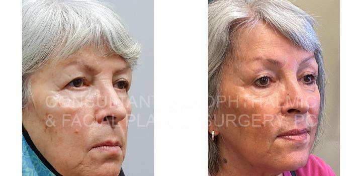Endoscopic Forehead and Brow Lift - Skin Tightening Treatment