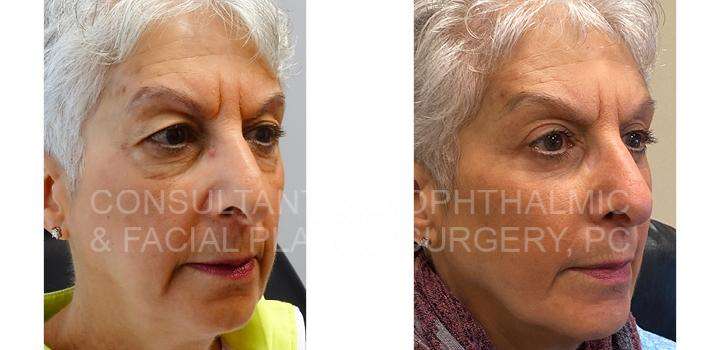 Blepharoplasty Both Upper Eyelids / Transconjunctival Excision Herniated Orbital Fat with Co2 Laser Skin Resurfacing of Both Lower Eyelids - Consultants in Ophthalmic and Facial Plastic Surgery