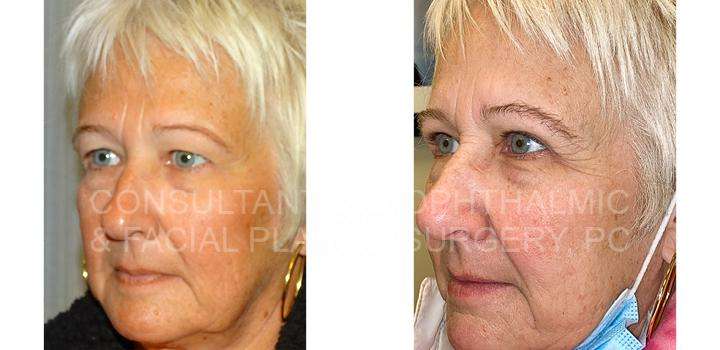 Blepharoplasty of Both Upper Eyelids - Consultants in Ophthalmic and Facial Plastic Surgery