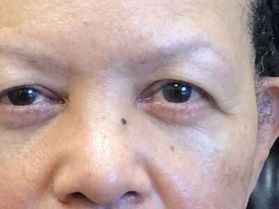 Is Lower Eyelid Blepharoplasty Worth It?