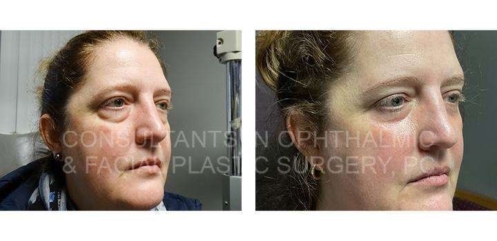 Transconjunctival Excision Herniated Orbital Fat with Co2 Laser Skin Resurfacing of Both Lower Lids