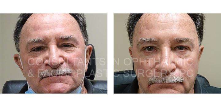 Repair of Entropion of Both Lower Eyelids