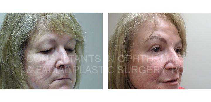 Blepharoplasty of both upper lids / Transconjunctival excision herniated orbital fat with CO2 laser skin resurfacing of both lower lids 3