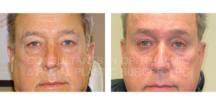 Endoscopic Forehead and Brow Lift / Repair Ptosis Both Upper Lids / Transconjunctival Excision Herniated Orbital Fat with Co2 Laser Skin Resurfacing of Both Lower Lids / Blepharoplasty of Both Upper Lids