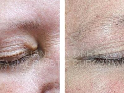 Excision of lesion of right upper eyelid with flap closure / Excision of lesion of left upper eyelid