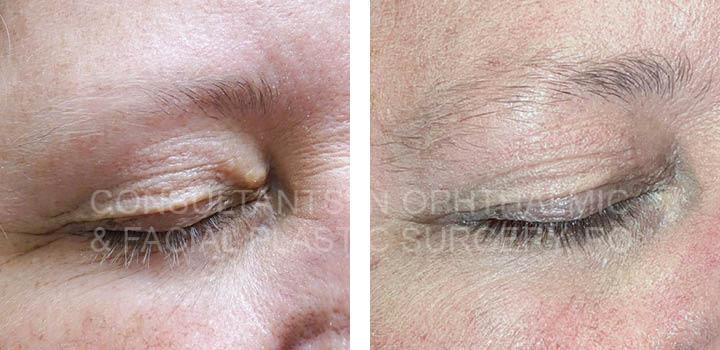 Excision of lesion of right upper eyelid with flap closure / Excision of lesion of left upper eyelid