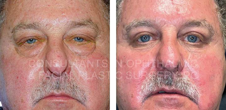 Repair Ptosis Both Upper Lids / Cosmetic Lower Lid Blepharoplasty with Excision of Herniated Orbital Fat of Both Lower Lids