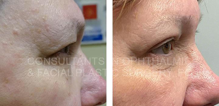 Endoscopic Forehead and Brow Lift / Transconjunctival Excision Herniated Orbital Fat with Co2 Laser Skin Resurfacing of Both Lower Lids / Blepharoplasty of Both Upper Lids