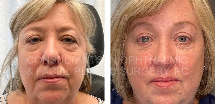 Endoscopic Forehead and Brow Lift / Transconjunctival Excision Herniated Orbital Fat with Co2 Laser Skin Resurfacing of Both Lower Lids / Blepharoplasty of Both Upper Lids