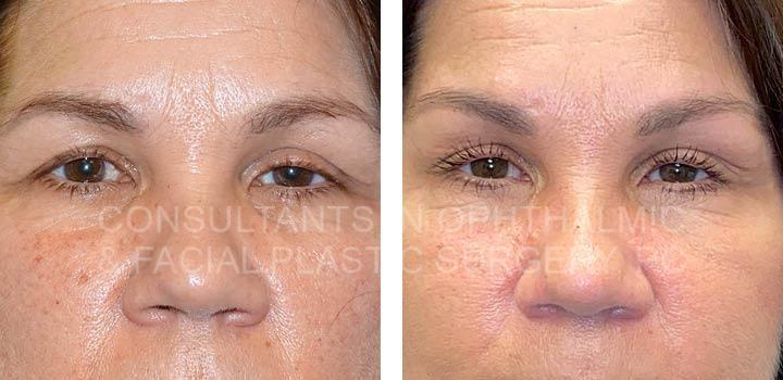 Endoscopic Forehead and Brow Lift / Repair Ptosis Both Upper Lids