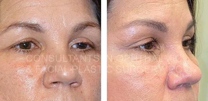 Endoscopic Forehead and Brow Lift / Repair Ptosis Both Upper Lids
