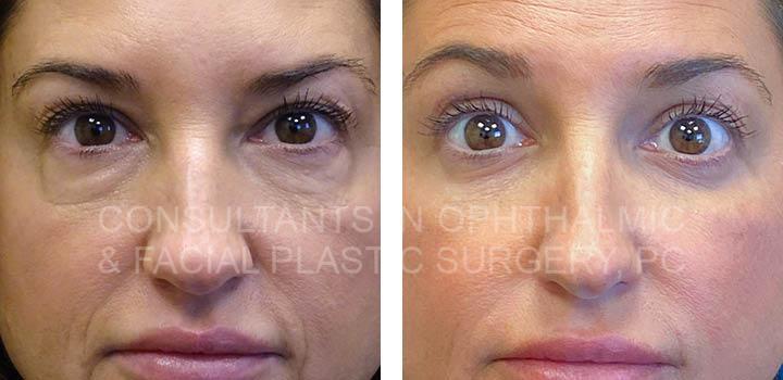 Left inferior orbitotomy with exploration and removal of orbital mass ...