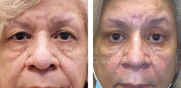 Blepharoplasty Right Upper Lid / Repair Ptosis Left Upper Lid / Transconjunctival Excision Herniated Orbital Fat of Both Lower Lids / Endoscopic Forehead and Brow Lift