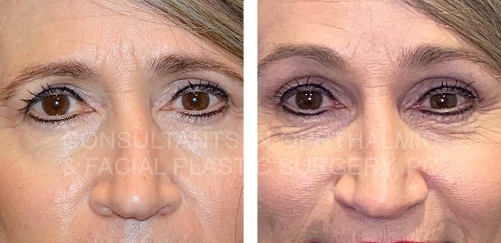 Endoscopic Forehead and Brow Lift