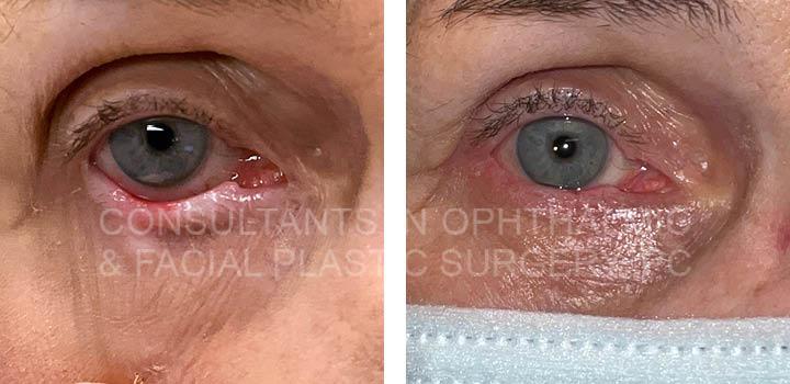 Excision lesion right lower lid with tissue rearrangement - Consultants ...