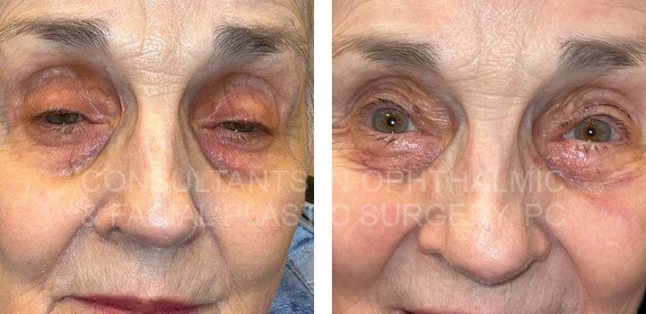 Repair Ptosis Right Upper Lid / Excision Excess Skin Right Upper Lid