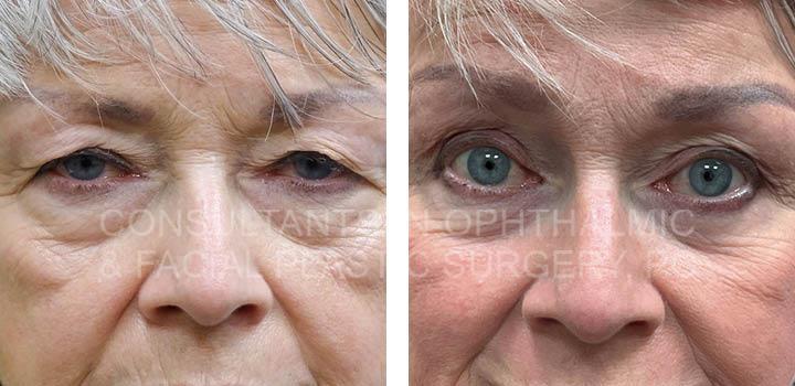 Endoscopic Forehead and Brow Lift / Transconjunctival Excision Herniated Orbital Fat with Co2 Laser Skin Resurfacing of Both Lower Lids / Blepharoplasty of Both Upper Eyelids
