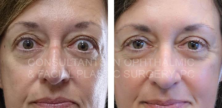 Retraction of Right Upper Eyelid / Right Lateral Canthoplasty