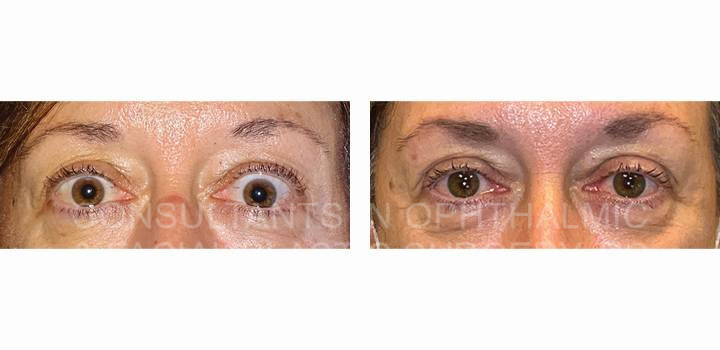 Retraction repair, both upper eyelids / Bilateral lateral canthoplasties