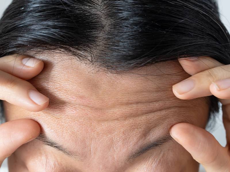 How Can I Get Rid of Wrinkles on My Forehead?