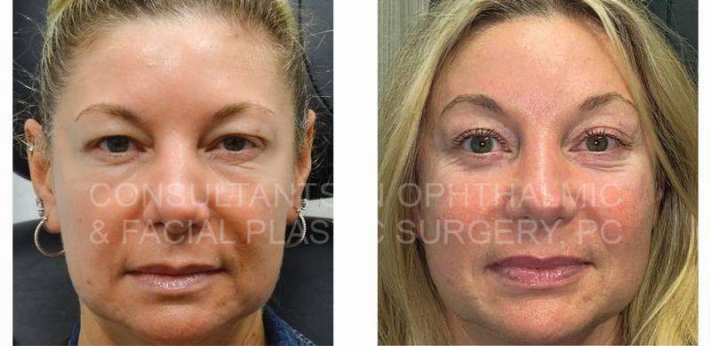 Endoscopic Forehead and Brow Lift / Blepharoplasty Both Upper Eyelids / Transconjunctival Excision Herniated Orbital Fat with Co2 Laser Skin Resurfacing of Both Lower Lids