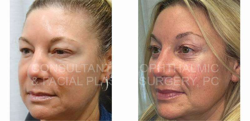 Endoscopic Forehead and Brow Lift / Blepharoplasty Both Upper Eyelids / Transconjunctival Excision Herniated Orbital Fat with Co2 Laser Skin Resurfacing of Both Lower Lids