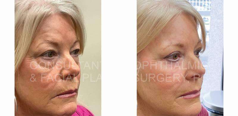 Blepharoplasty of Both Upper Lids / Transconjunctival Excision Herniated Orbital Fat with Co2 Laser Skin Resurfacing of Both Lower Lids