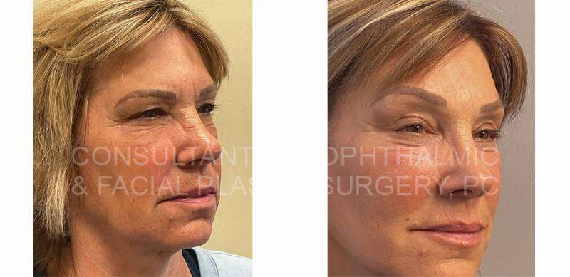 Endoscopic Forehead and Brow Lift / Blepharoplasty of Both Upper Lids / Co2 Laser Skin Resurfacing Both Lower Lids