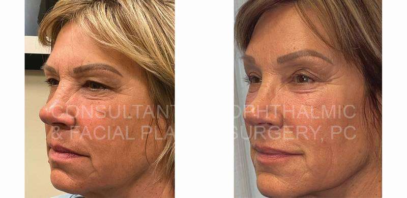 Endoscopic Forehead and Brow Lift / Blepharoplasty of Both Upper Lids / Co2 Laser Skin Resurfacing Both Lower Lids