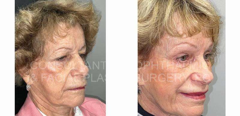 Endoscopic Forehead and Brow Lift