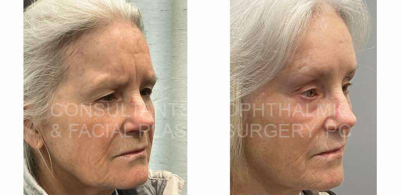 Endoscopic Forehead and Brow Lift / Blepharoplasty of Both Upper Lids / Transconjunctival Excision Herniated Orbital Fat with Co2 Laser Skin Resurfacing of Both Lower Lids