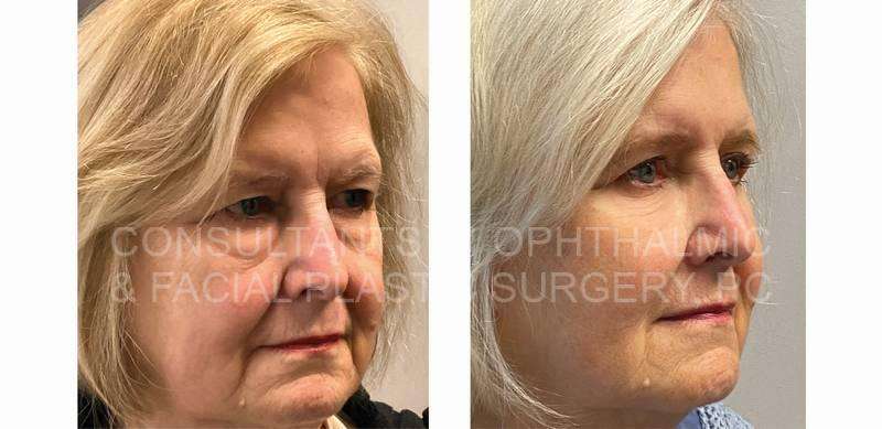 Blepharoplasty of Both Upper Lids / Transconjunctival Excision Herniated Orbital Fat with Co2 Laser Skin Resurfacing of Both Lower Lids