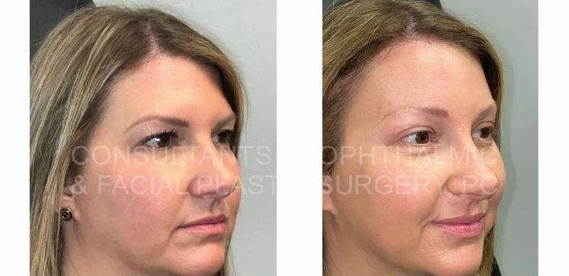 Endoscopic Forehead and Brow Lift / Blepharoplasty of Both Upper Lids
