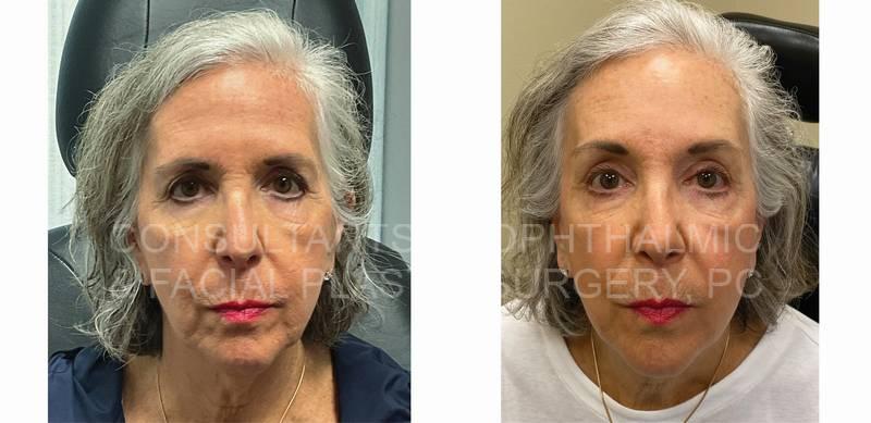 Endoscopic Forehead and Brow Lift / Co2 Laser Skin Resurfacing of Both Lower Lids