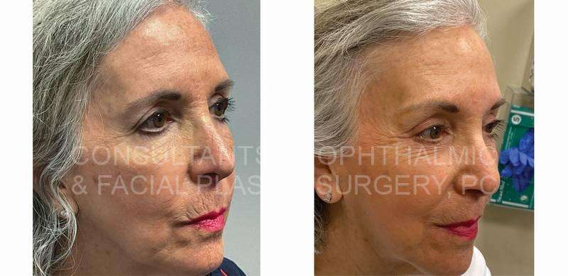 Endoscopic Forehead and Brow Lift / Co2 Laser Skin Resurfacing of Both Lower Lids