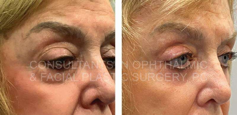 Repair Ptosis Both Upper Lids / Transconjunctival Excision Herniated Orbital Fat with Co2 Laser Skin Resurfacing of Both Lower Lids