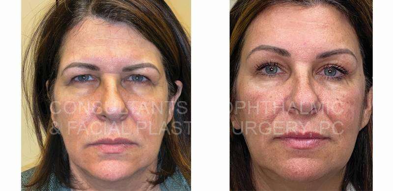 Endoscopic Forehead and Brow Lift / Blepharoplasty of Both Upper Lids