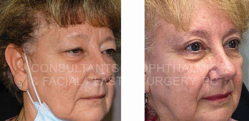 Endoscopic Forehead and Brow Lift / Repair Ptosis Both Upper Lids / Blepharoplasty of Both Upper Lids / Debulk and Excission of Herniated Fat Both Upper Lids