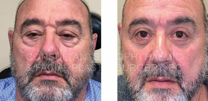 Repair Ptosis Both Upper Lids / Transconjunctival Excision Herniated Orbital Fat with Co2 Laser Skin Resurfacing of Both Lower Lids