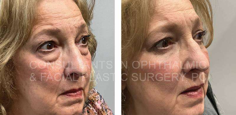 Transconjunctival Excision Herniated Orbital Fat with Co2 Laser Skin Resurfacing of Both Lower Lids / Blepharoplasty of Both Upper Lids