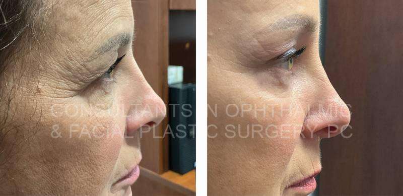 Endoscopic Forehead and Brow Lift / Blepharoplasty of Both Upper Lids / Transconjunctival Excision Herniated Orbital Fat with Co2 Laser Skin Resurfacing of Both Lower Lids